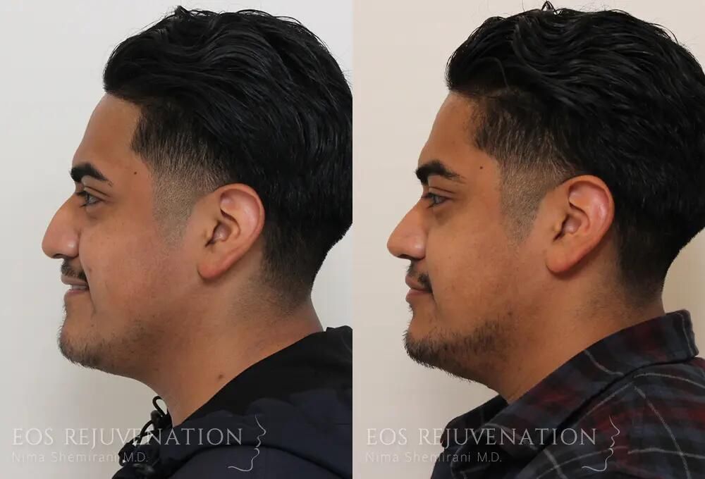 Rhinoplasty Before & After