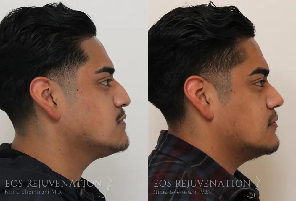 Rhinoplasty Before & After