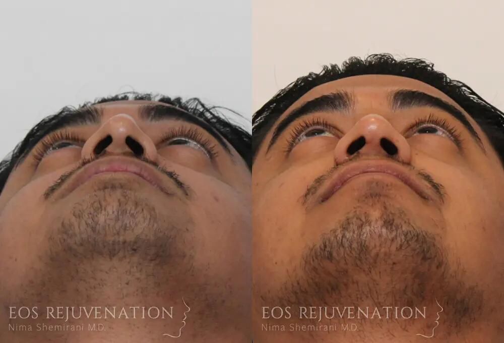 Rhinoplasty Before & After