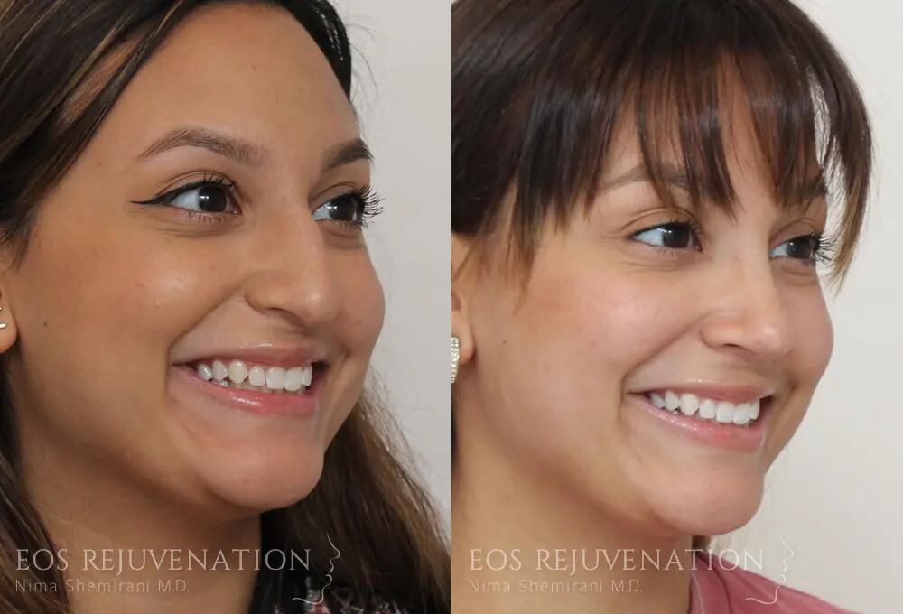 Rhinoplasty Before & After