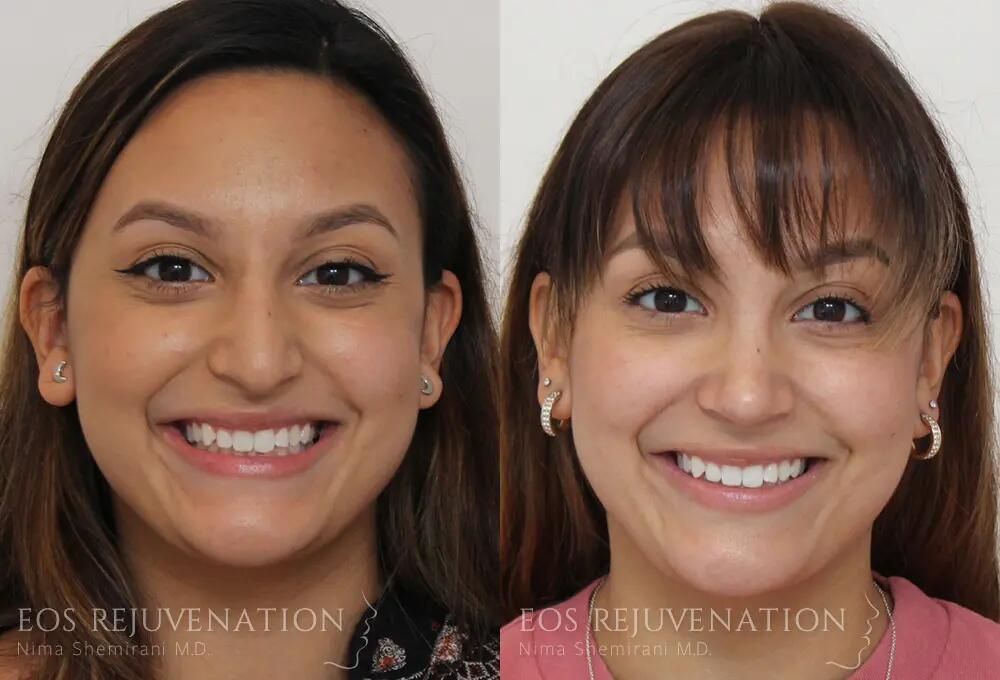 Rhinoplasty Before & After