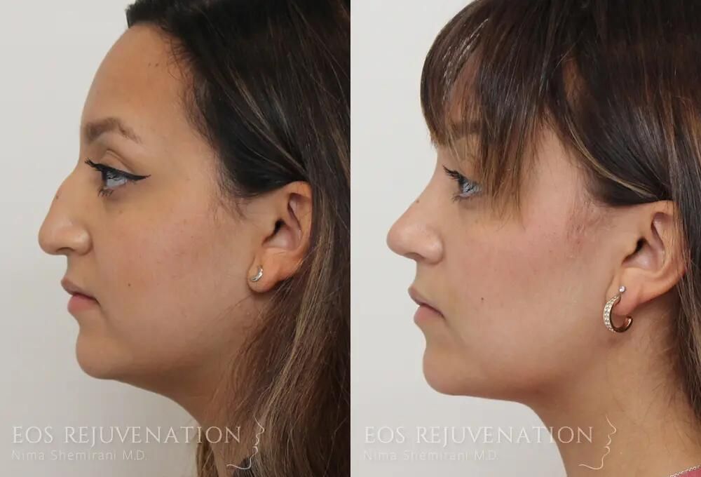 Rhinoplasty Before & After