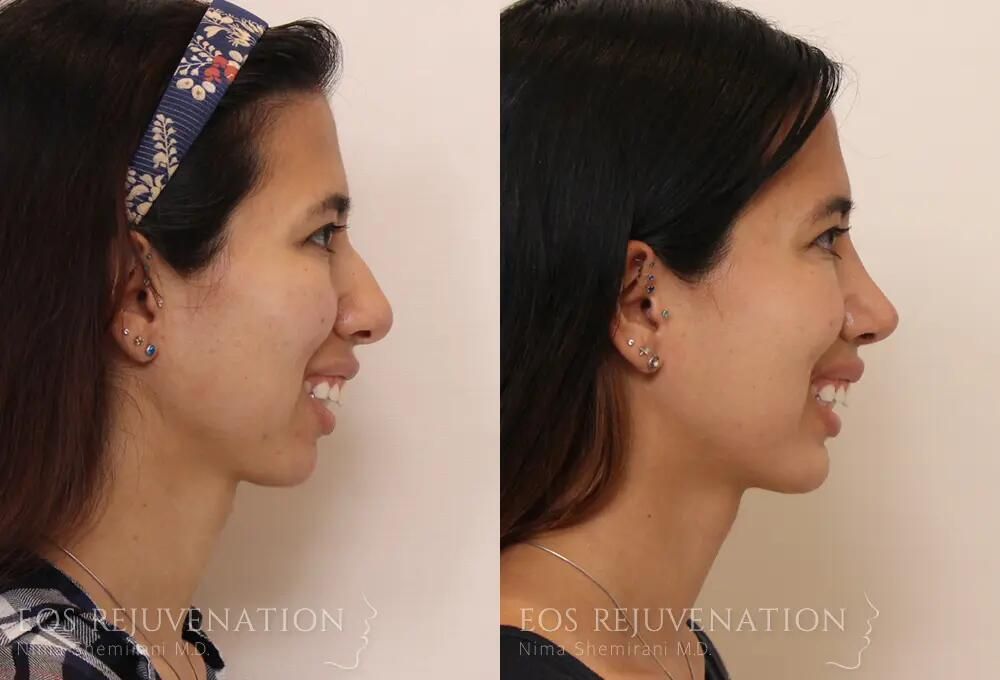 Rhinoplasty Before & After
