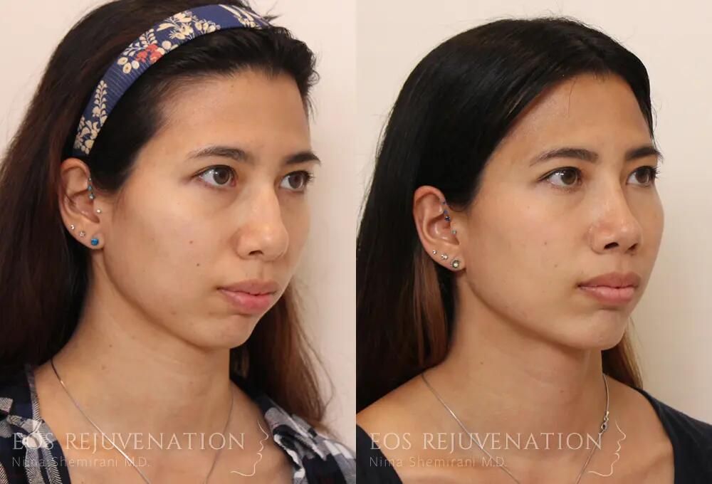 Rhinoplasty Before & After