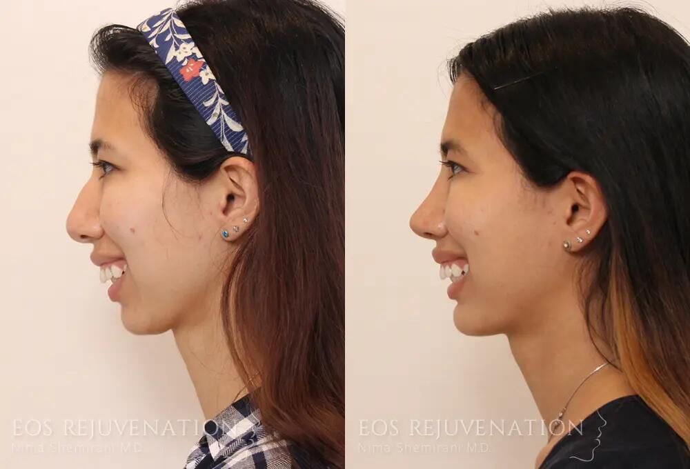 Rhinoplasty Before & After
