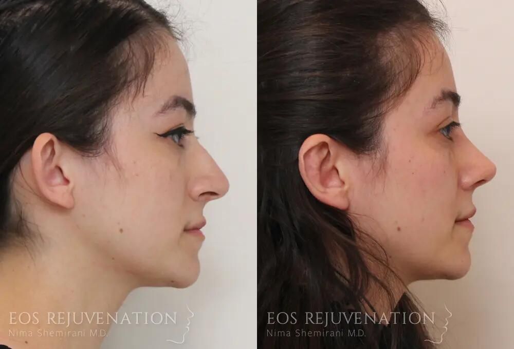 Rhinoplasty Before & After
