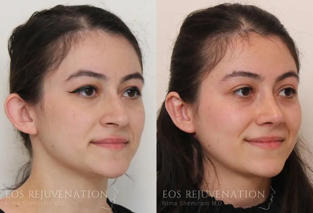 Rhinoplasty Before & After