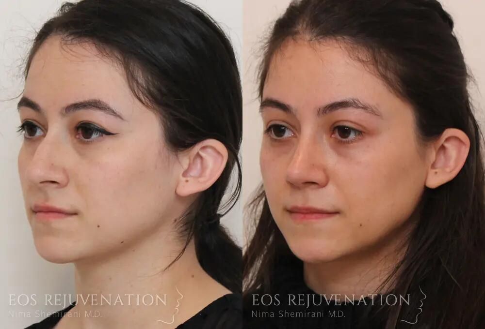 Rhinoplasty Before & After
