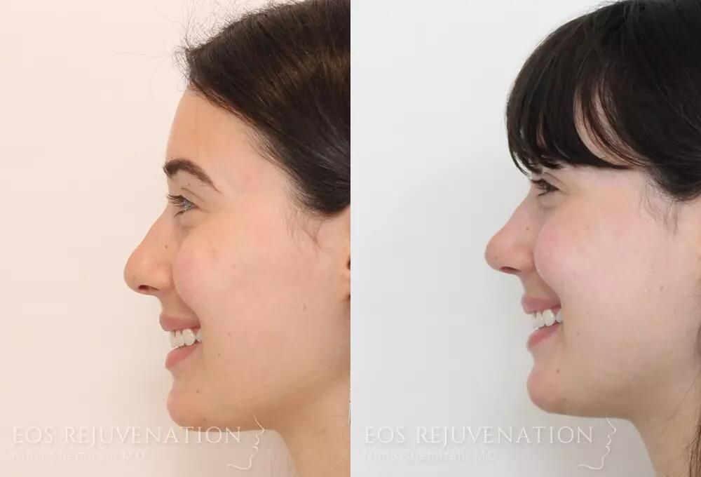 Rhinoplasty Before & After