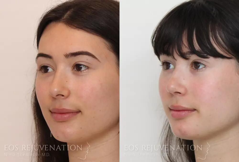 Rhinoplasty Before & After
