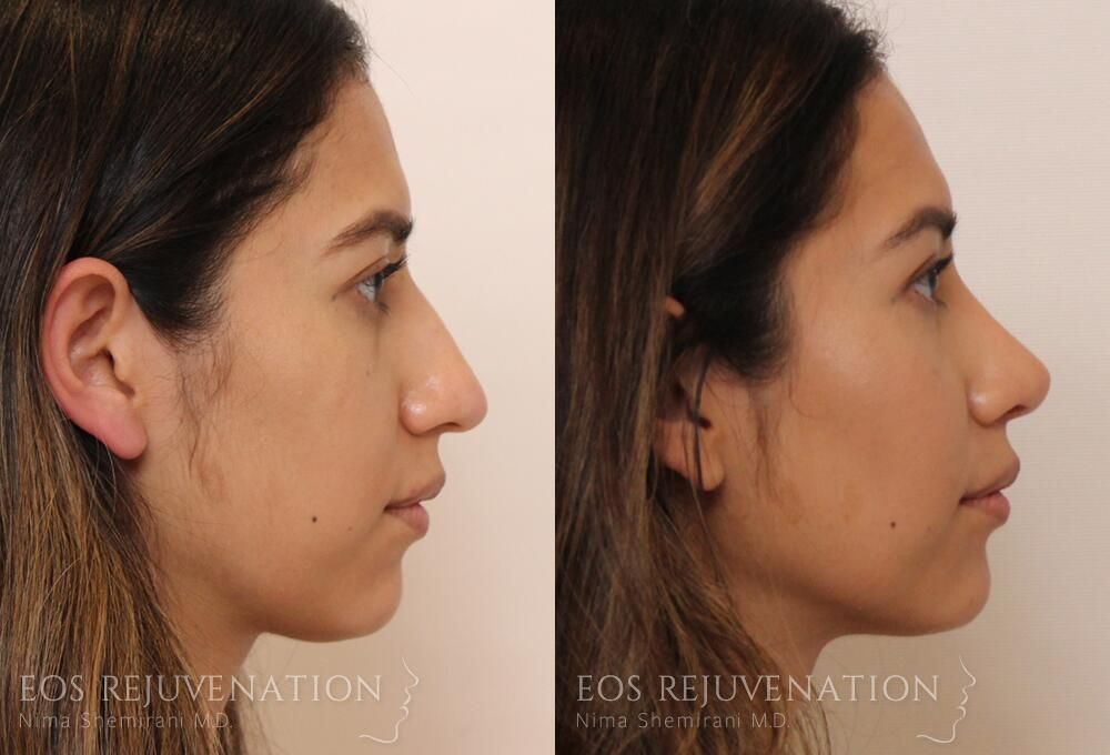 Rhinoplasty Before & After