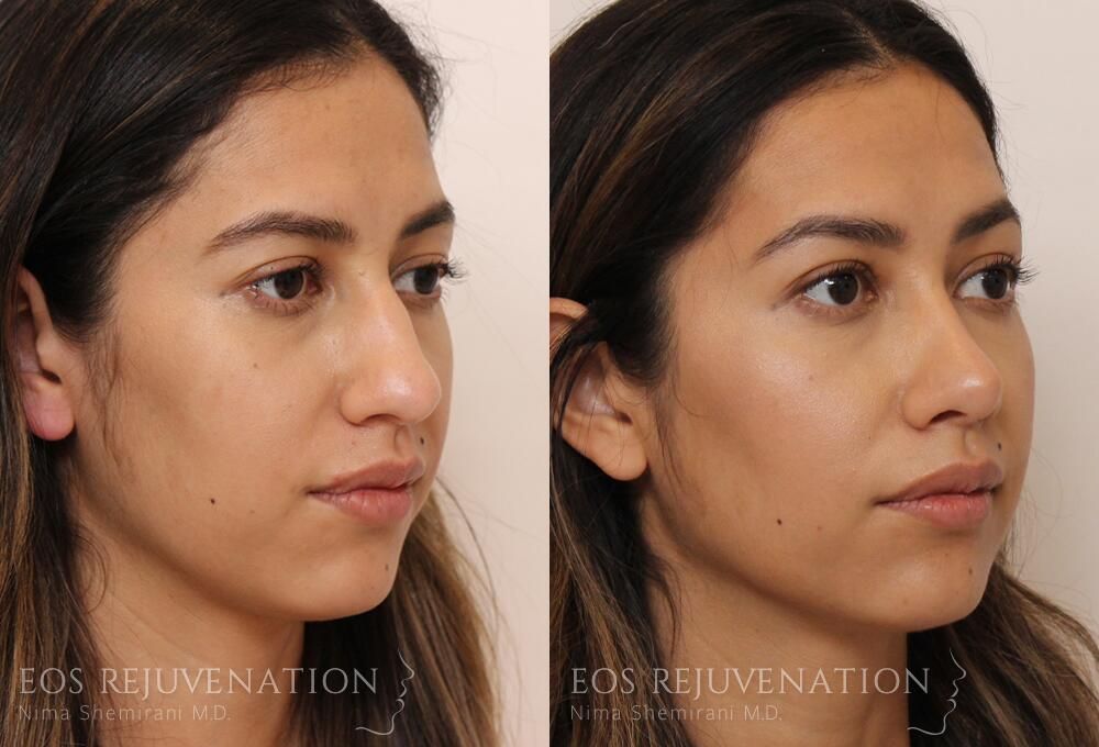 Rhinoplasty Before & After