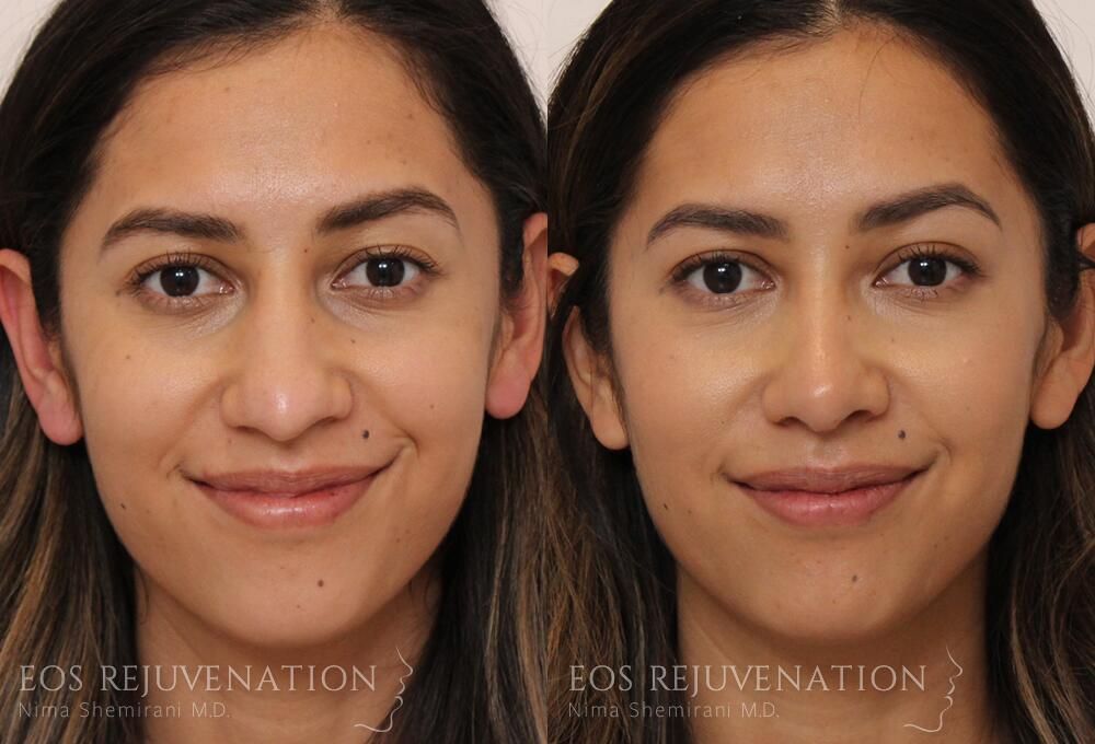 Rhinoplasty Before & After