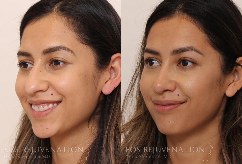 Rhinoplasty Before & After
