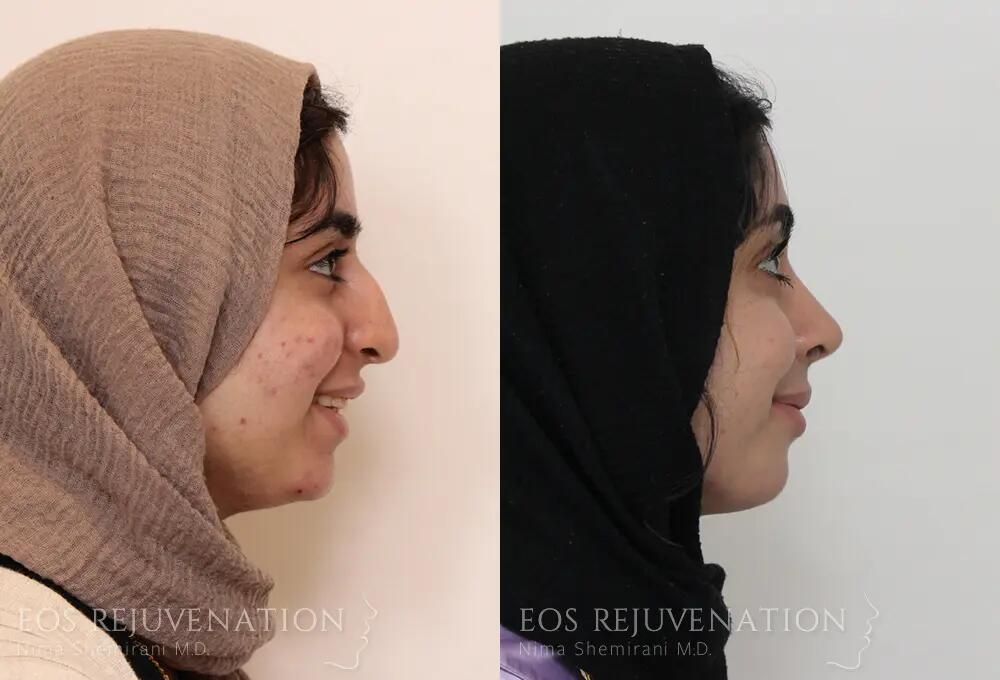 Rhinoplasty Before & After