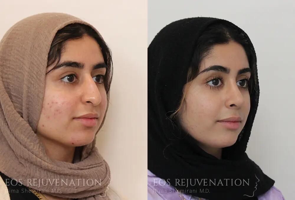 Rhinoplasty Before & After