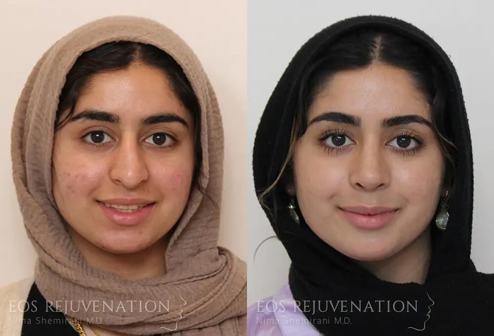 Rhinoplasty Before & After