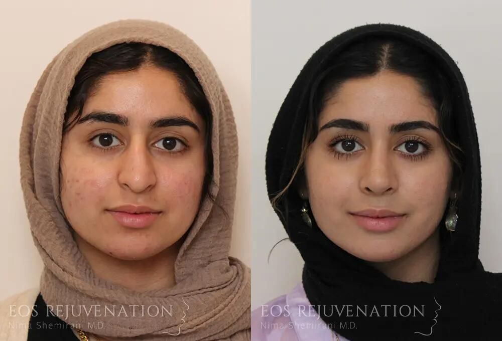 Rhinoplasty Before & After