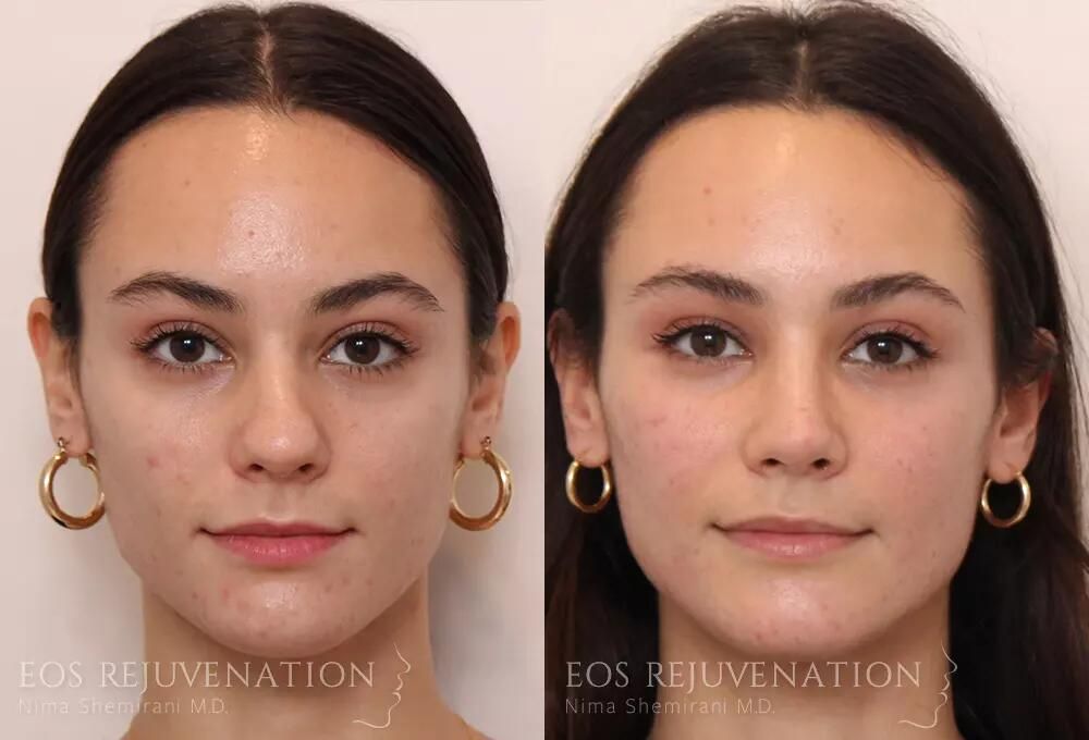 Rhinoplasty Before & After