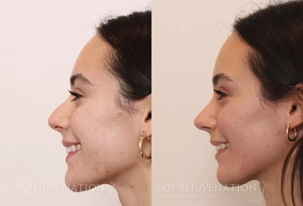Rhinoplasty Before & After