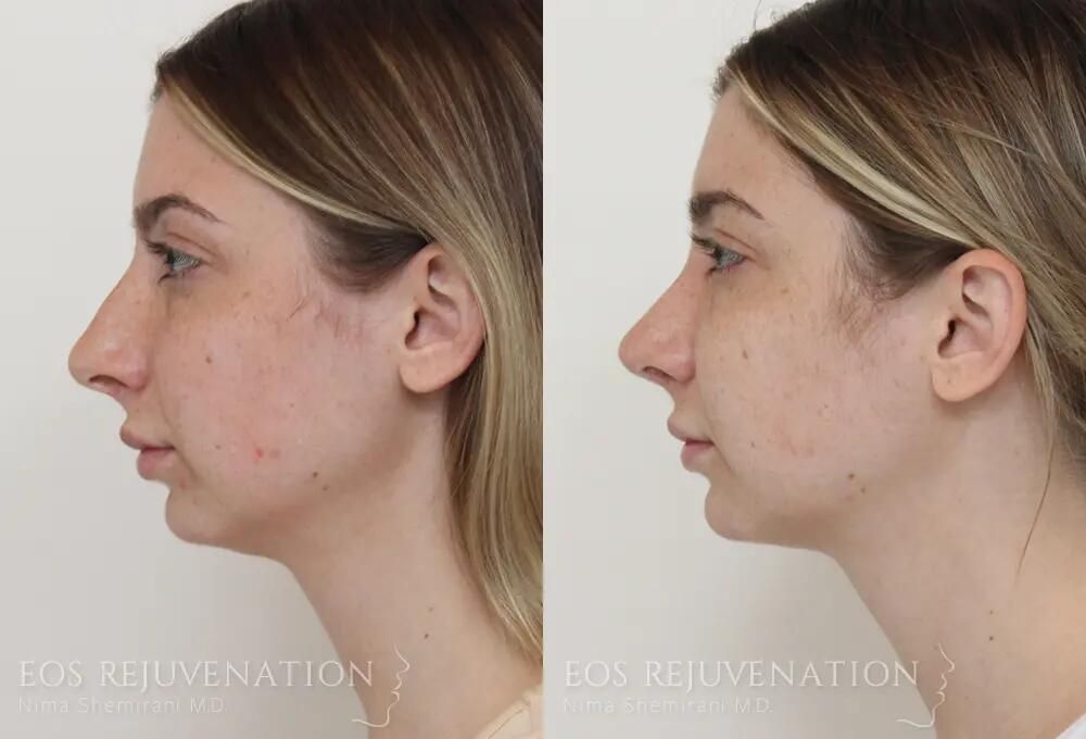 Rhinoplasty Before & After