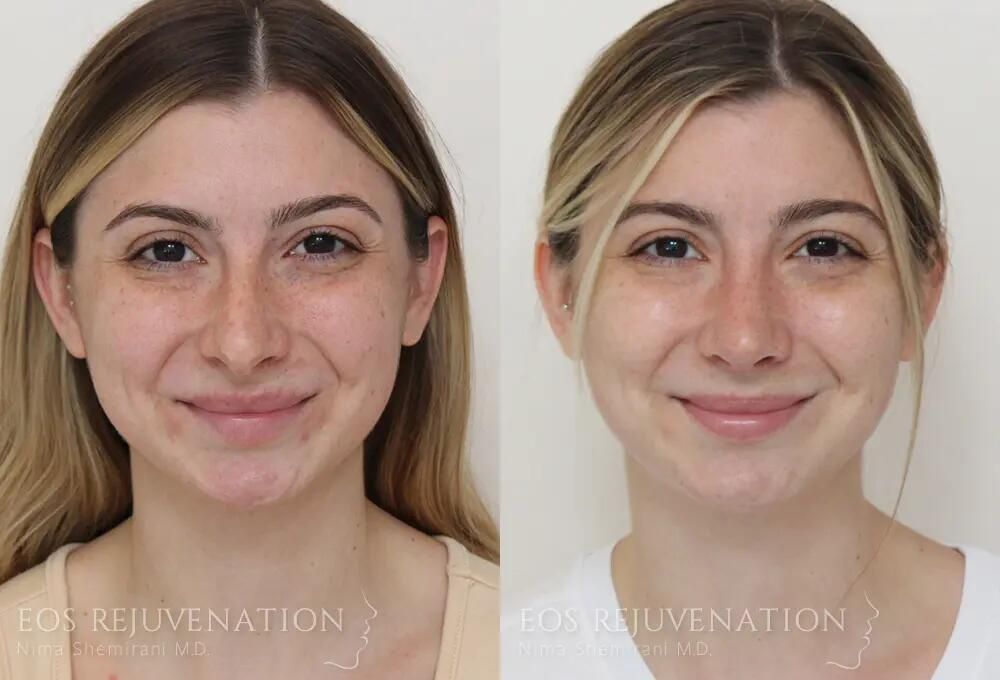 Rhinoplasty Before & After