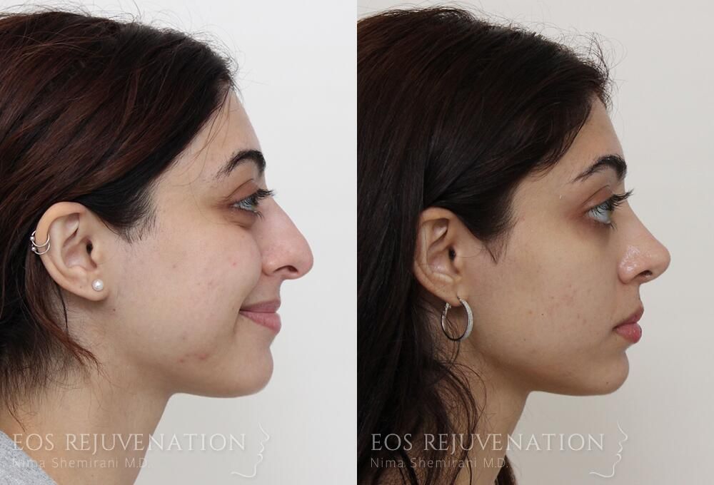 Rhinoplasty Before & After