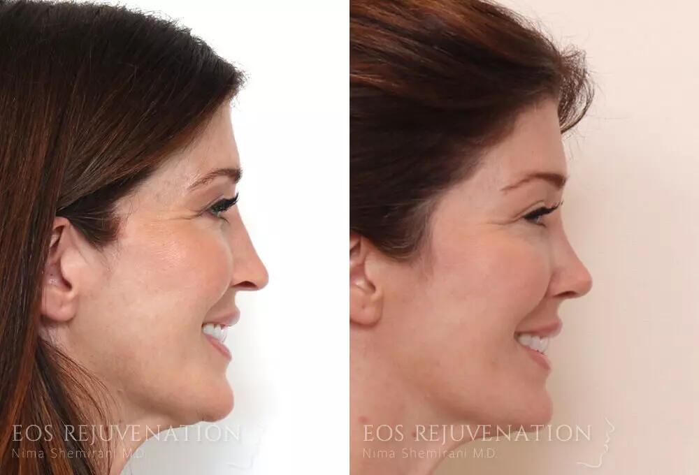 Rhinoplasty Before & After