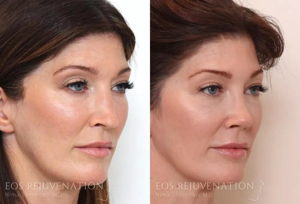 Rhinoplasty Before & After