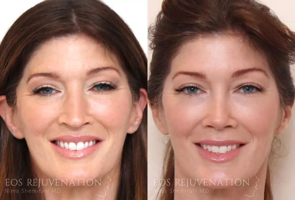 Rhinoplasty Before & After