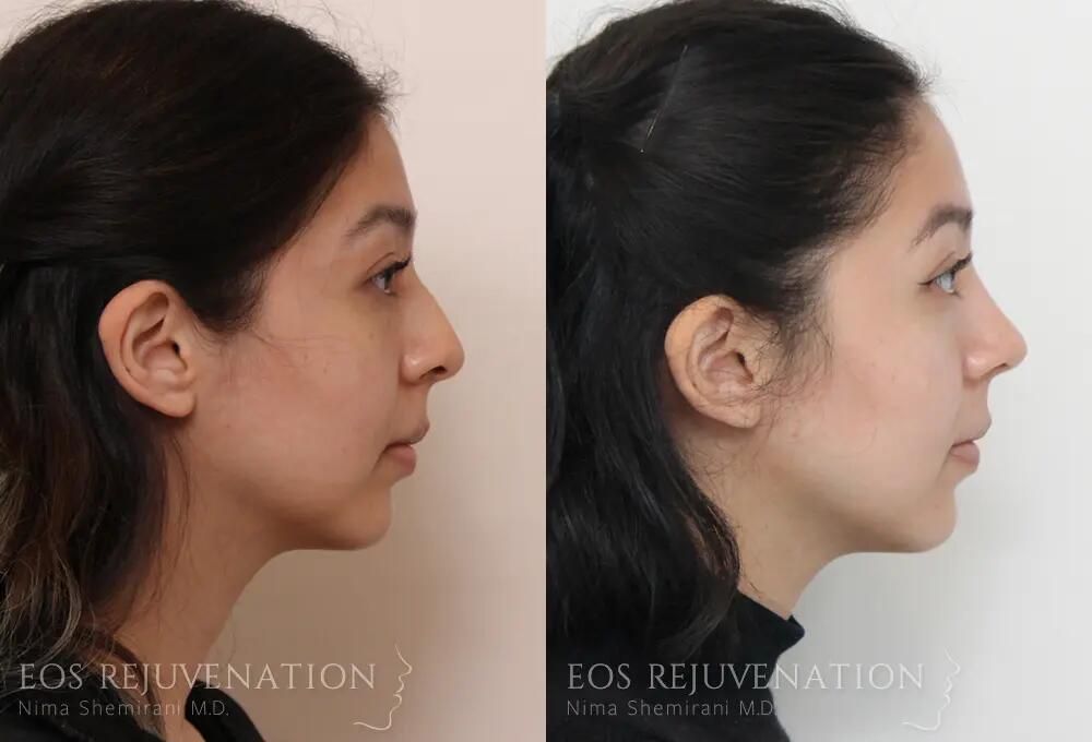 Rhinoplasty Before & After