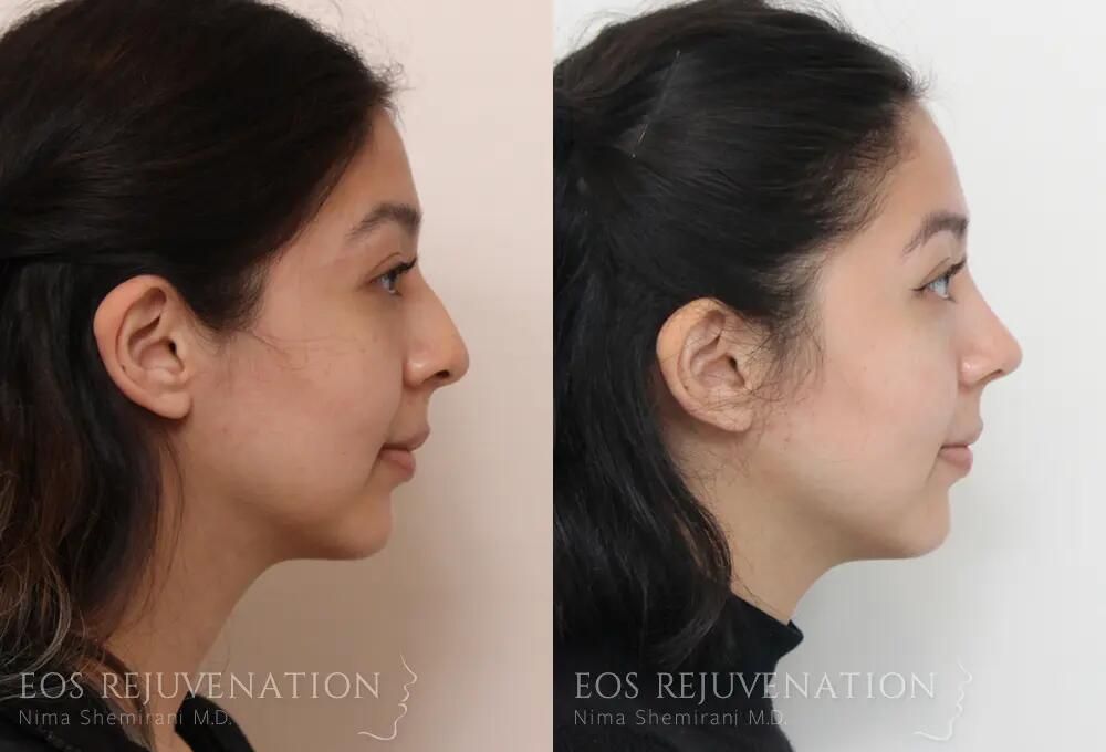 Rhinoplasty Before & After