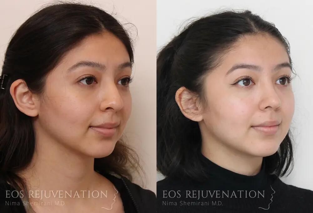 Rhinoplasty Before & After