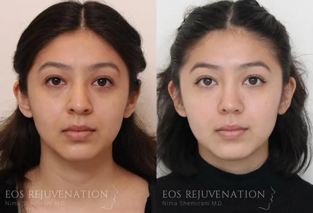 Rhinoplasty Before & After