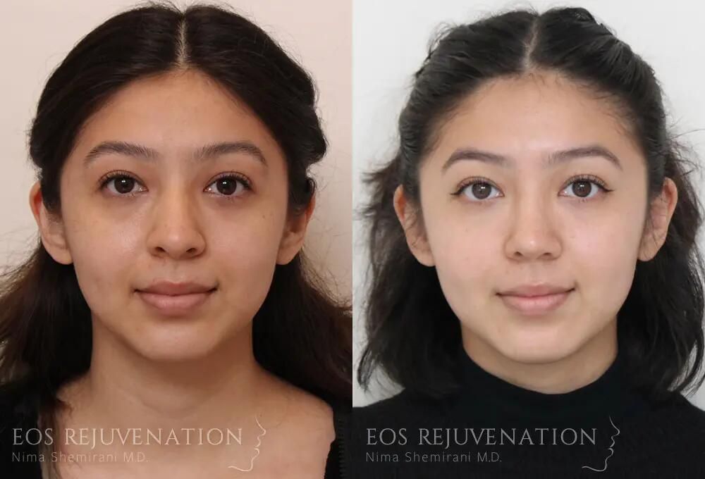 Rhinoplasty Before & After