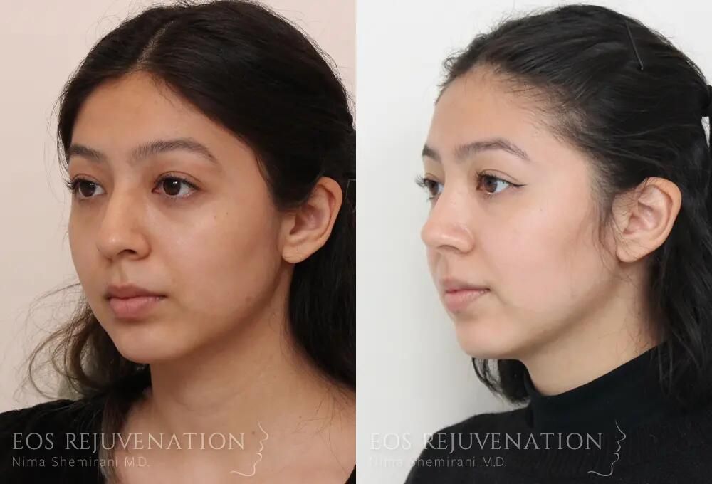 Rhinoplasty Before & After