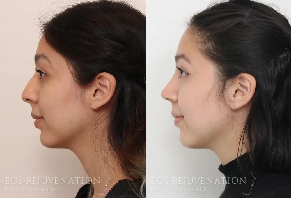 Rhinoplasty Before & After