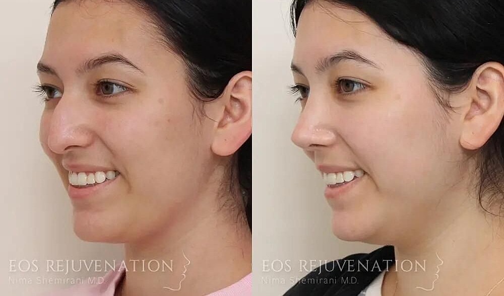 Rhinoplasty Before & After