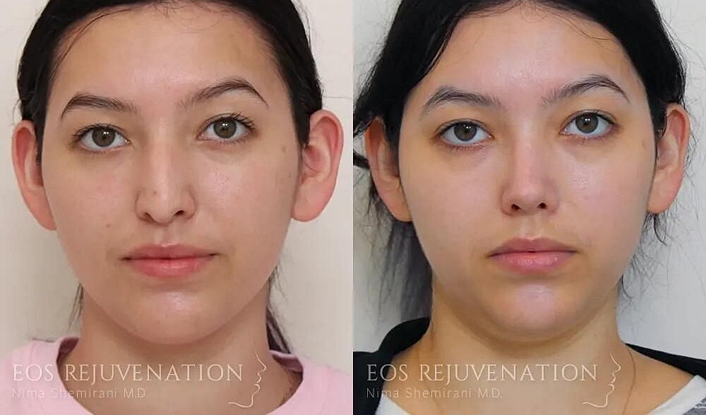 Rhinoplasty Before & After