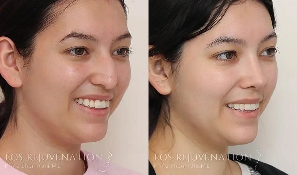 Rhinoplasty Before & After