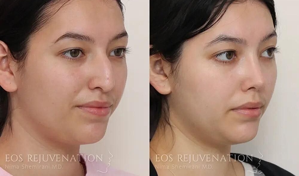 Rhinoplasty Before & After