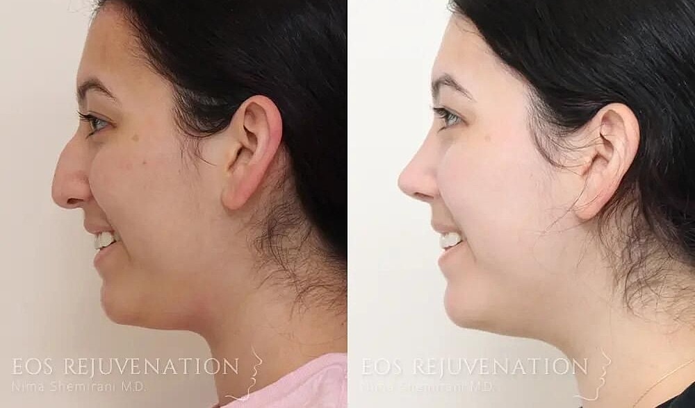 Rhinoplasty Before & After