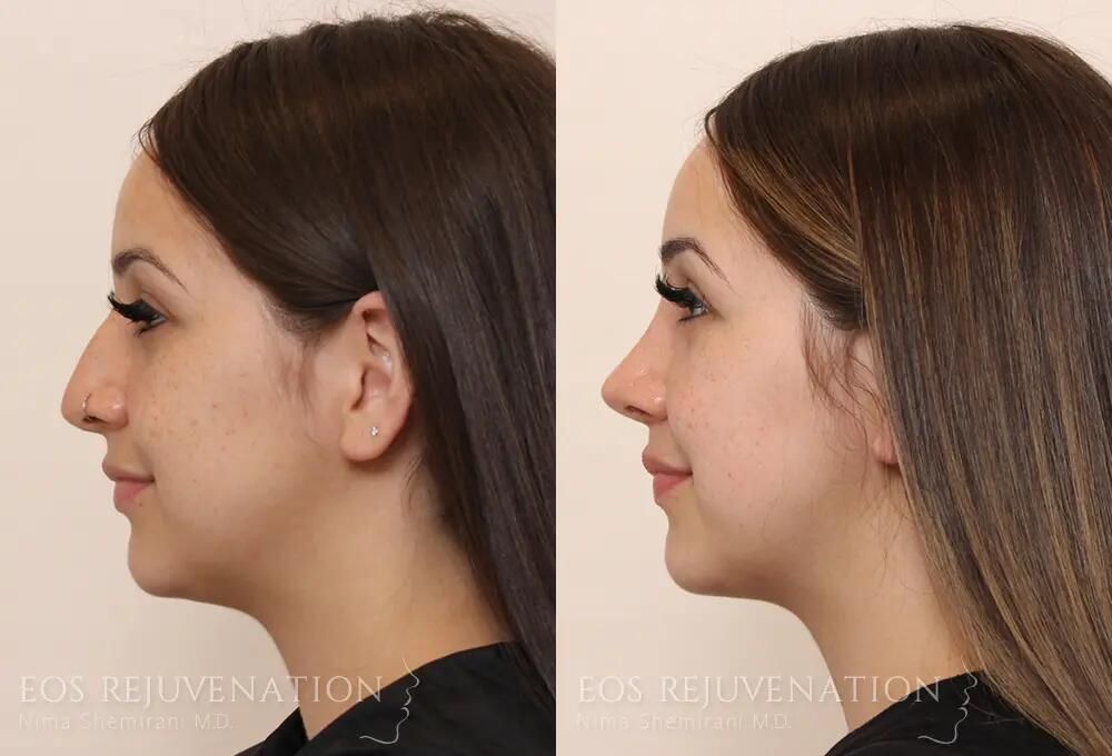 Rhinoplasty Before & After