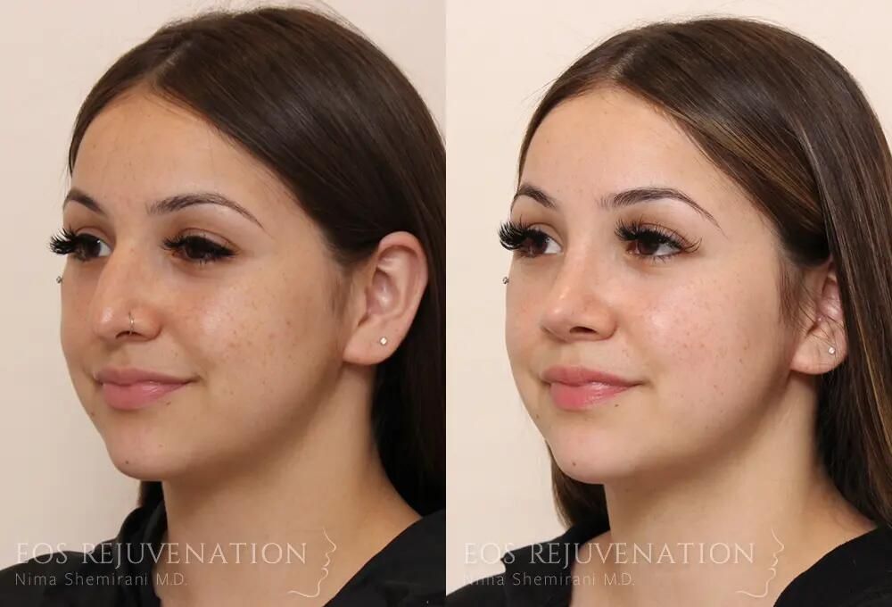 Rhinoplasty Before & After
