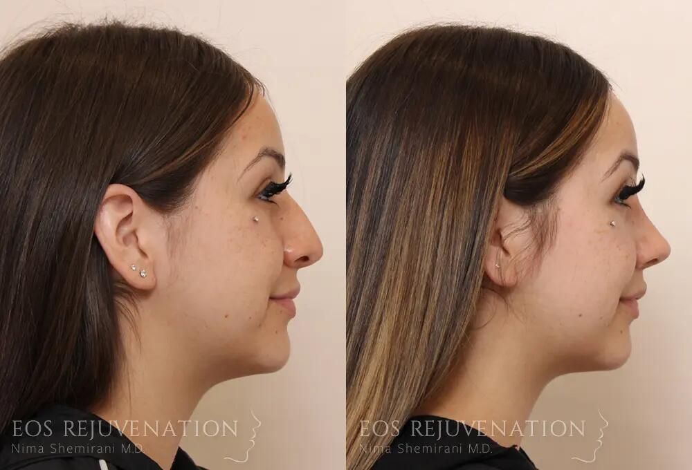 Rhinoplasty Before & After