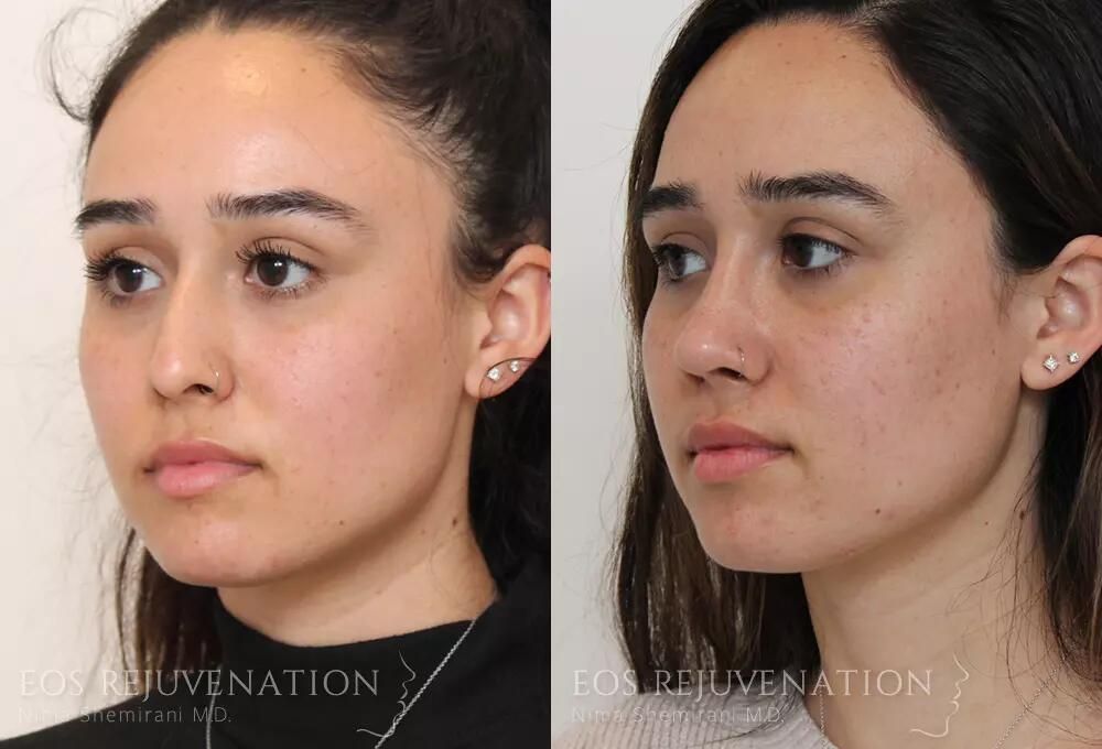 Rhinoplasty Before & After