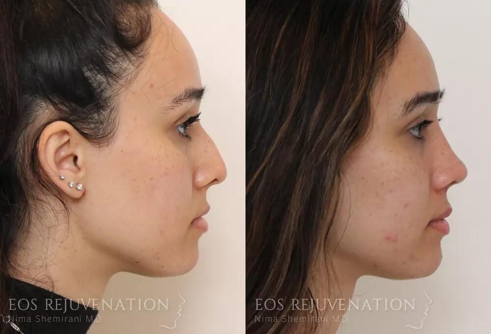Rhinoplasty Before & After