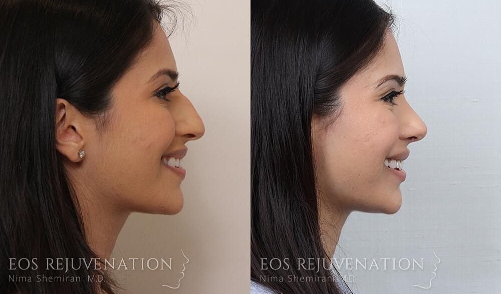Rhinoplasty Before & After
