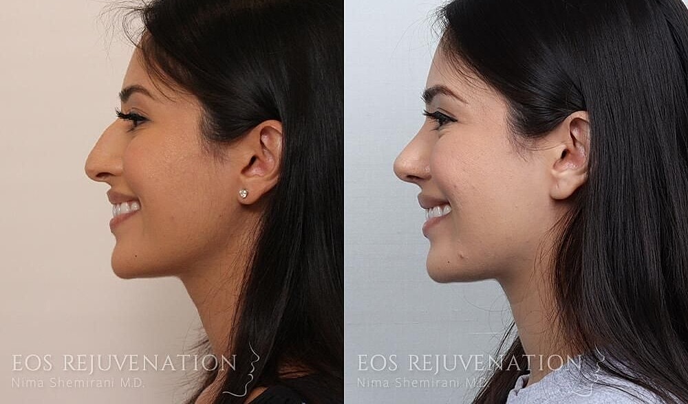 Rhinoplasty Before & After