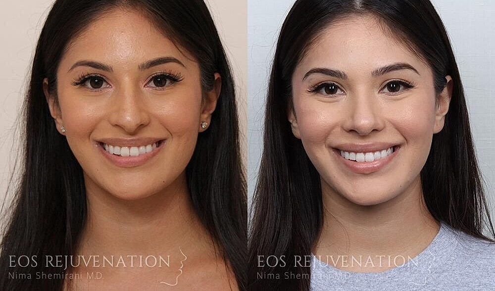 Rhinoplasty Before & After